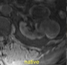 Папиллярная почечно-клеточная карцинома фото